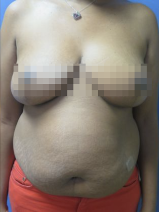 Devlin Cosmetic Surgery patient after breast lift with reduction