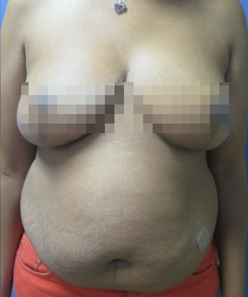 Devlin Cosmetic Surgery patient after breast lift with reduction