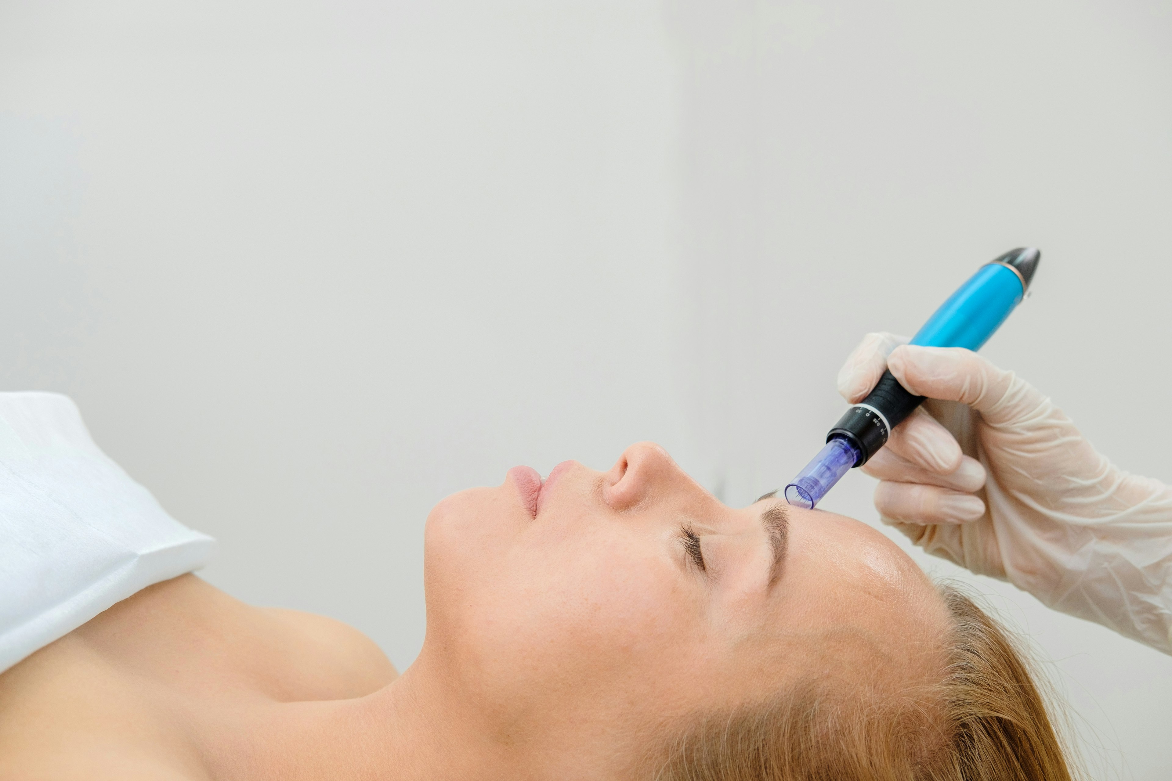 Woman getting microneedling treatment