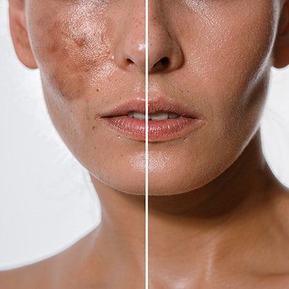 Woman before and after hyperpigmentation treatment