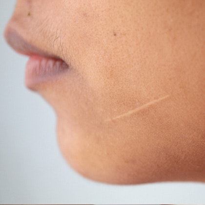 Scar on woman's cheek
