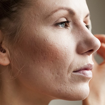 Woman with acne