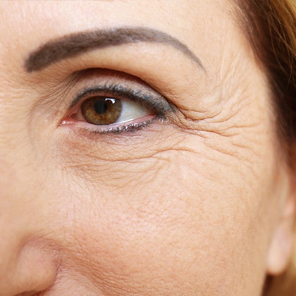 Woman's wrinkled eye area
