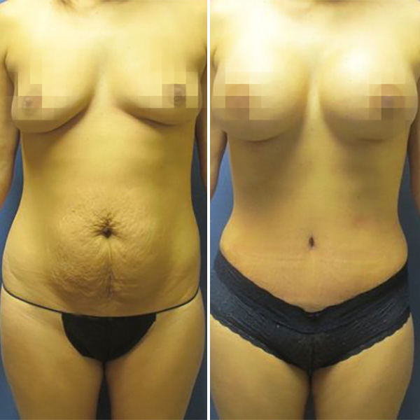 Breast Augmentation for Small Breasts - Little Rock, AR - Dr. Yee