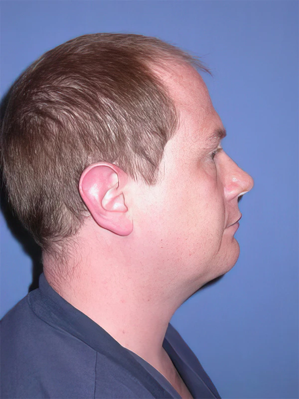Man in profile after chin liposuction with a chin implant