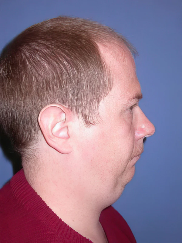 Man in profile before chin liposuction