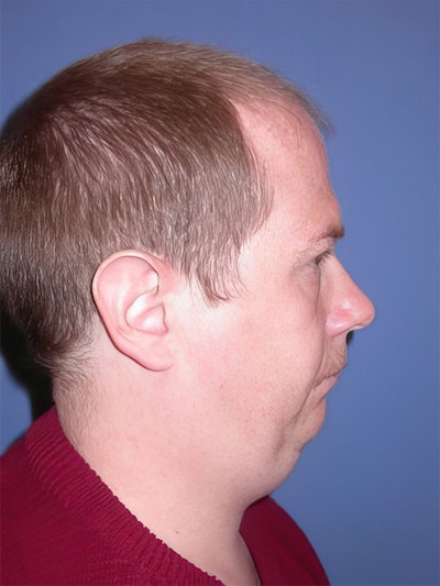 man's chin before liposuction