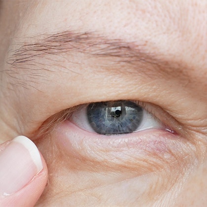 Sagging Eyelids