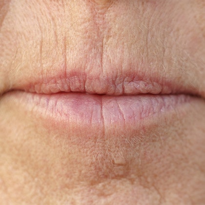 Lip Lines