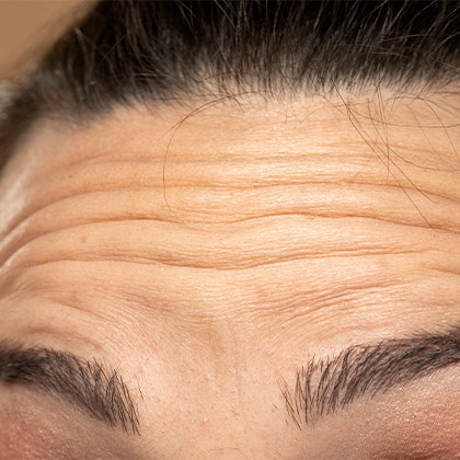 Forehead Wrinkles