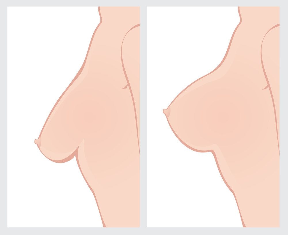 before and after a breast lift