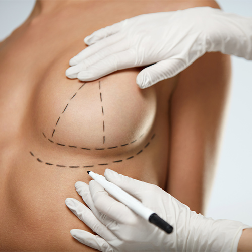 Breast Reduction Procedure Steps  American Society of Plastic Surgeons