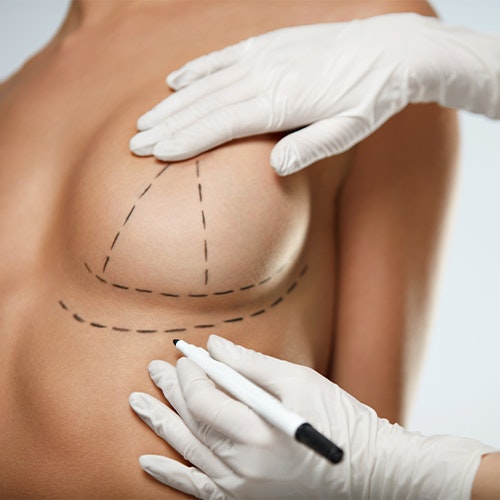cosmetic surgeon planning a breast lift