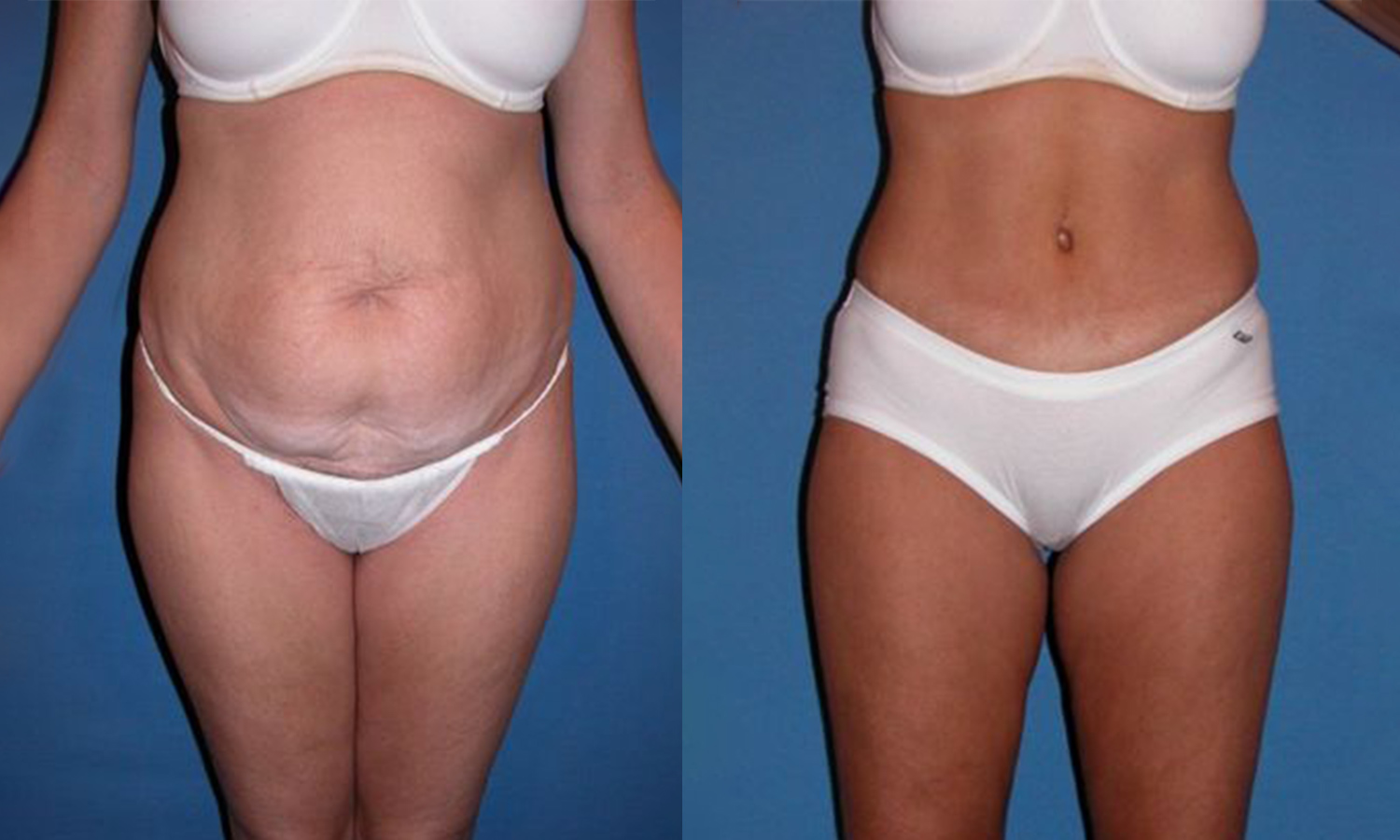 Surprising health benefits of a tummy tuck panty