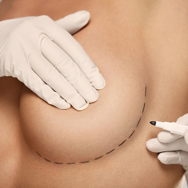Breast Lift Little Rock, AR - Conway, AR - Hot Springs, AR - Mastopexy -  Devlin Cosmetic Surgery: Michael Devlin, M.D.