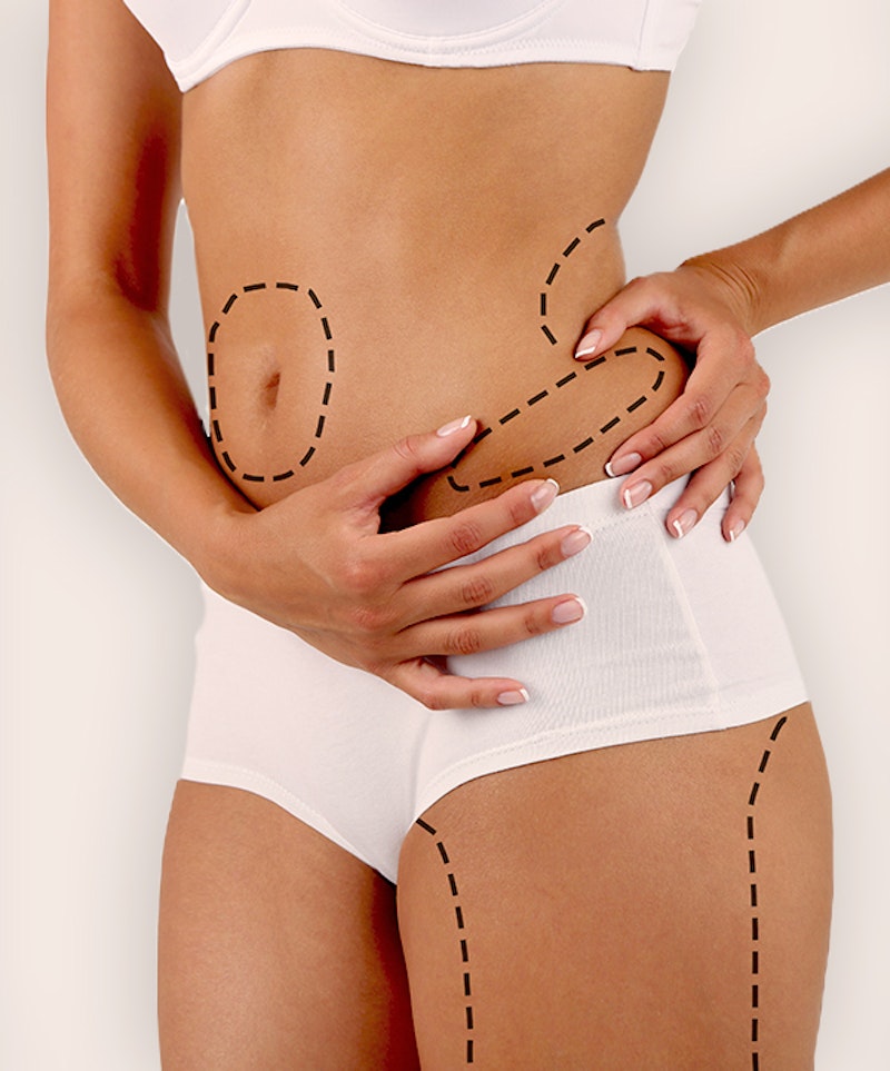 woman with markings for mommy makeover procedures