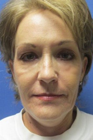 woman after a chemical peel