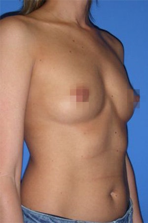 Before breast augmentation