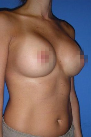 After breast augmentation