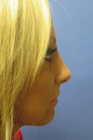 Girl after rhinoplasty