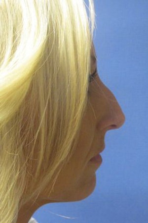 Girl before rhinoplasty