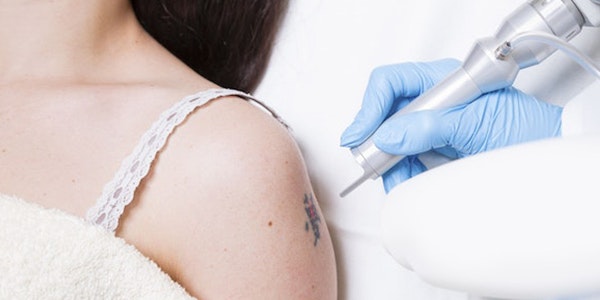 Woman receiving laser tattoo removal on arm