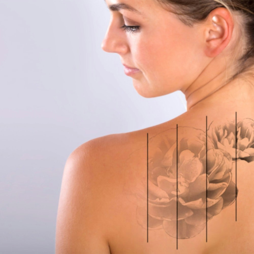 Woman with fading tattoo on her back, showing tattoo at each treatment stage
