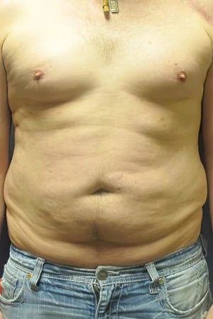 Man before liposuction