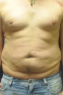 man before liposuction