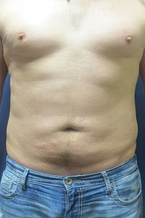 man after liposuction