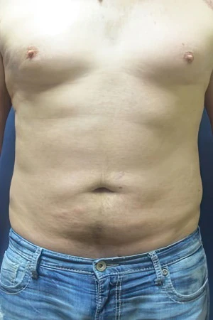 Man after liposuction of the abdomen and waist