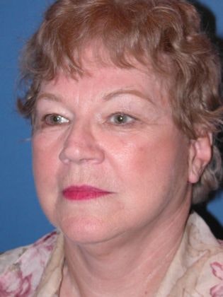 a woman after having a neck lift