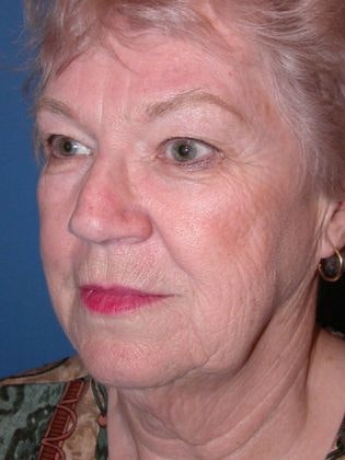 a woman before having a neck lift