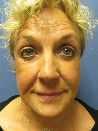a woman before facelift surgery