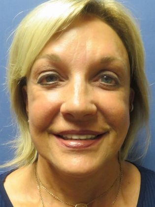 a woman after facelift surgery