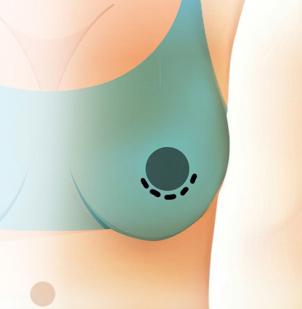 Illustration of a periareolar incision