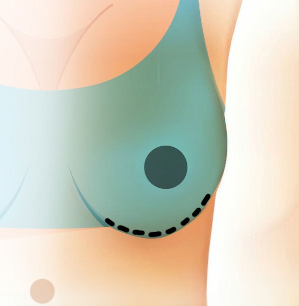 Illustration of an inframammery incision