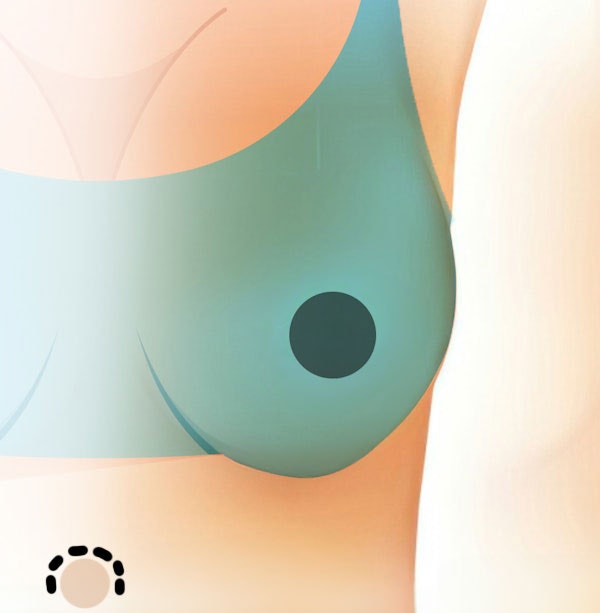 Illustration of a tuba incision