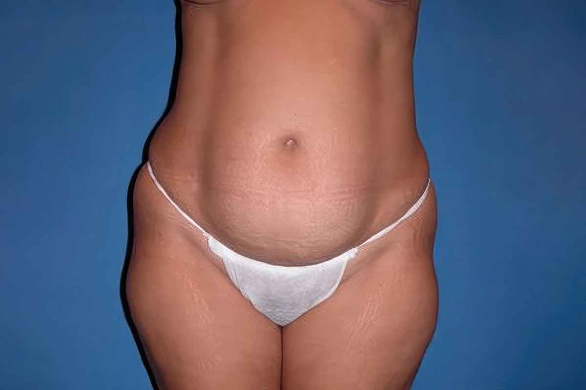 Dr. Michael Devlin's patient before tummy tuck and liposuction