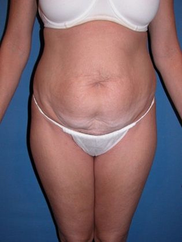 Devlin Cosmetic Surgery patient before tummy tuck