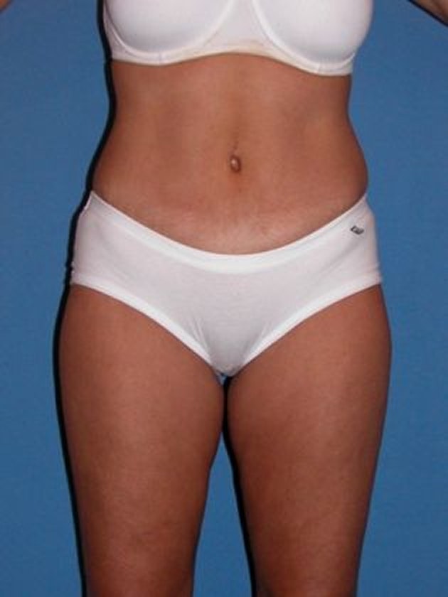 Devlin Cosmetic Surgery patient after tummy tuck