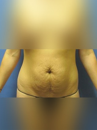 Devlin Cosmetic Surgery patient before mommy makeover