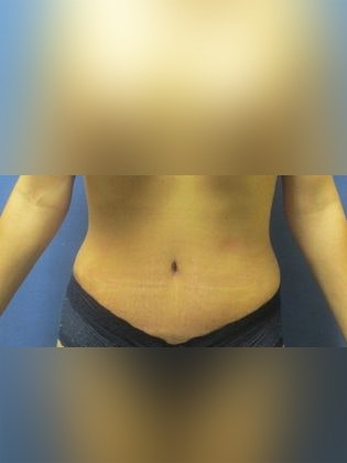 Devlin Cosmetic Surgery patient after mommy makeover