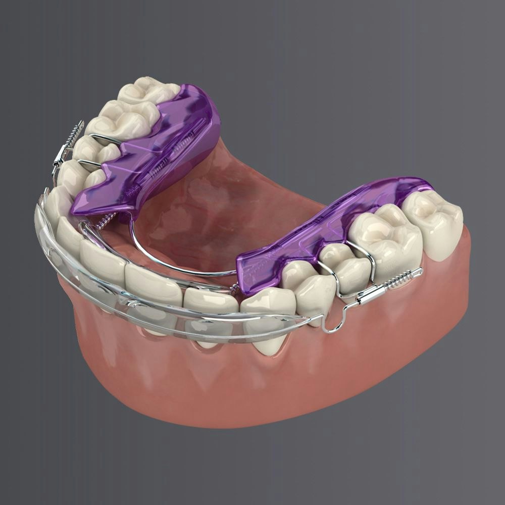 Illustration of Inman Aligner