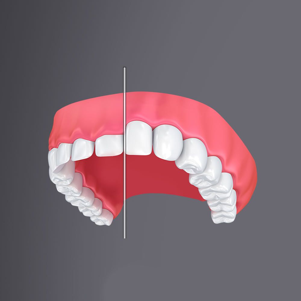 Before and after gum contouring