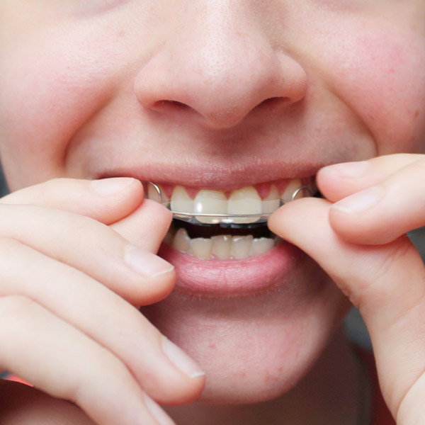 Woman wearing Inman Aligner