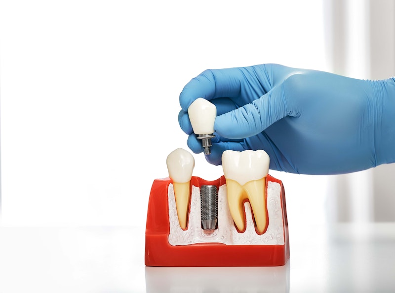 Person placing a crown on a dental implant model