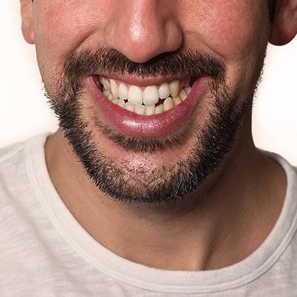 man with a chipped tooth
