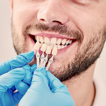 veneers in different shades tested against a man's smile