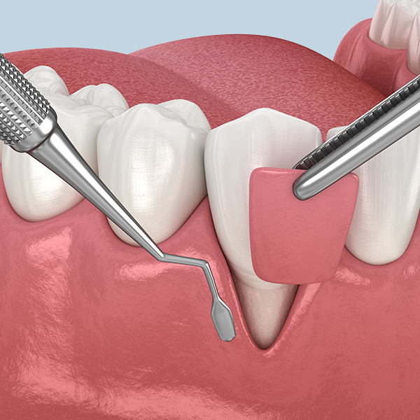 illustration demonstrating the gum contouring procedure